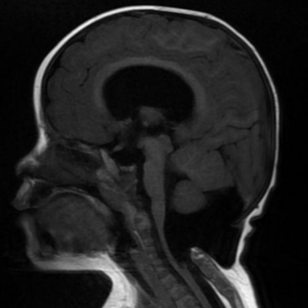 MRI Cerebro-spinal sagittal T1