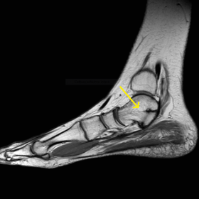 Sagittal proton density-weighted MR of right foot