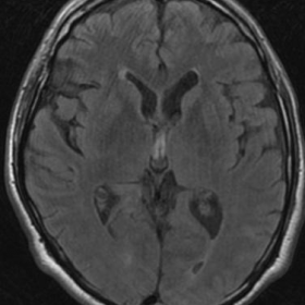 MRI performed 3 hours after the symptoms onset