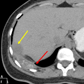 MDCT scan (axial view – plain)