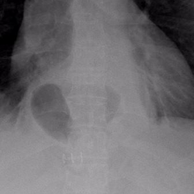 Plain chest radiograph (from upper gastrointestinal series)