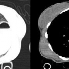 Same axial CT slices with lung and mediastinal windows respectively