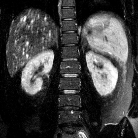 MRI lumbosacral spine