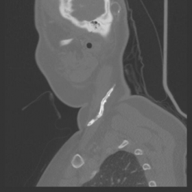 CT neck without contrast sagittal / bone window.