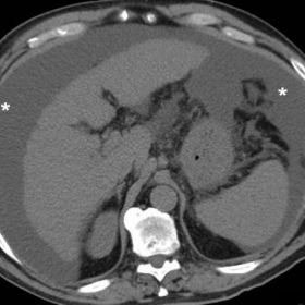 Unenhanced and multiphase contrast-enhanced CT one year earlier