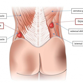 Illustration of lumbar hernia