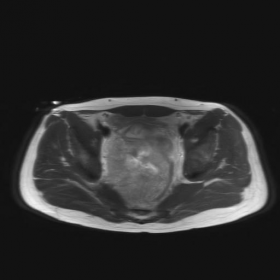 T2W images of a primary presacral choriocarcinoma