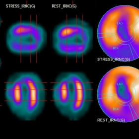 Stress and rest myocardial perfusion imaging