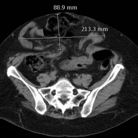 Unenhanced CT and measurements