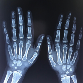 X-ray of both hands AP