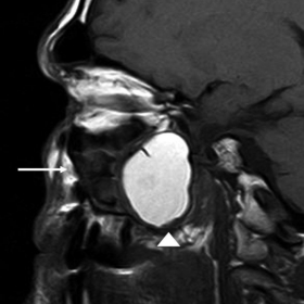 Non-enhanced T1-weighted sagittal MRI