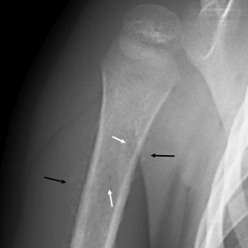 Anterioposterior radiography of the right proximal humerus.