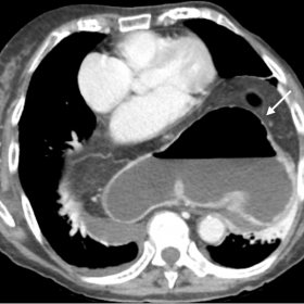 Enhanced CT in venous phase in axial plane. Enhanced CT in axial plane showing a giant hiatal hernia containing the stomach (
