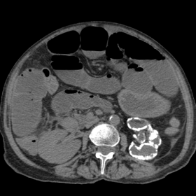 Non contrast CT abdomen soft tissue window showing deformed left kidney with diffuse cortical calcification suggestive of put