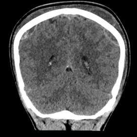 Unenhanced CT, coronal reconstruction: small hyperdense biparietal EDHs