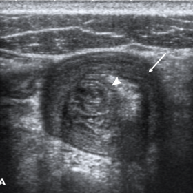 When the bowel is imaged in a transverse plane the intussusceptum (arrowhead) is seen within inside the intussuscipiens (arro