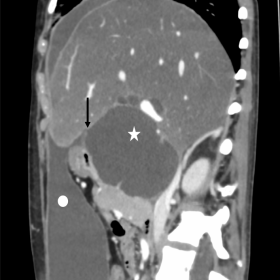 Sagittal reformatted image of contrast-enhanced CT of the abdomen showing a large peripherally vascularised cyst (white star)