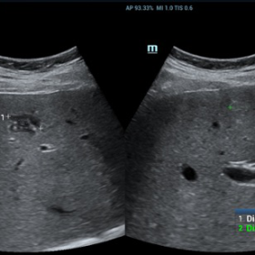 Bmode ultrasound: inhomogeneous mass located in S5 of the liver