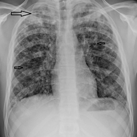 Chest radiograph showing extensive bilateral reticulonodular consolidation, predominantly affecting the upper and mid zones, some with cavitation (large arrow). In addition, there are some ring shadows suggestive of cysts (small arrows)