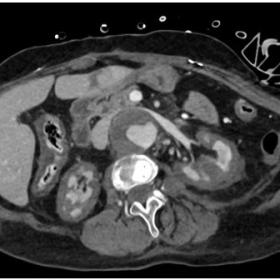 Axial projection of an abdominopelvic contrast-enhanced CT in a venous phase displays the kidney “inverse rim sign”, characteristic of acute renal cortical necrosis. Other findings such as a partially thrombosed aneurysm, a hepatic infarction focus and a hypodense thickening of the colonic wall, consistent with colitis, are demonstrated.