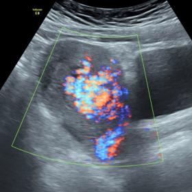 Transabdominal colour Doppler US demonstrating intense myometrial hypervascularisation with turbulent flow.