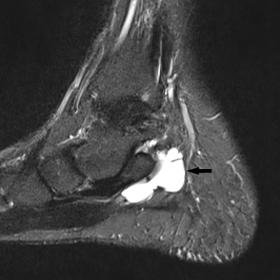 Sagittal STIR image shows a lobulated cystic lesion along the medial aspect of the calcaneum posterior to the flexor digitorum longus tendon.