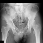 Normal Rx right hip