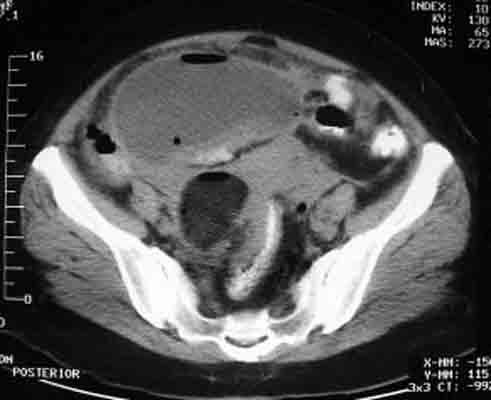 abscess adnexal rupture cyst intra abdominal dermoid eurorad ovarian