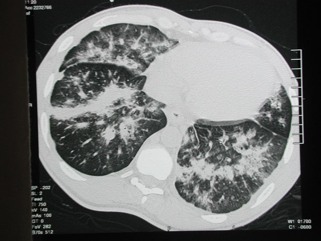 Ct Findings Of Pulmonary Kaposis Sarcoma In A Patient With Aids Eurorad