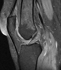 Patellar tendon-lateral femoral condyle friction syndrome | Eurorad