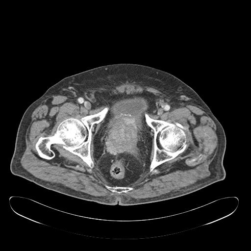 Prostate Cancer Ct Findings Eurorad