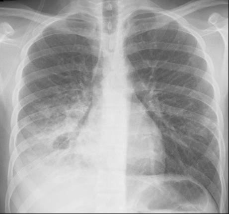 Endobronchial spread of tuberculosis | Eurorad