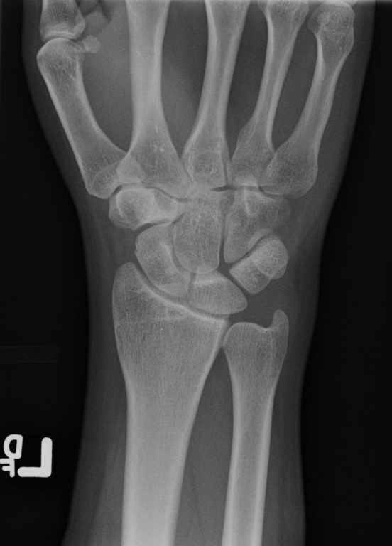 Isolated capitate fracture | Eurorad