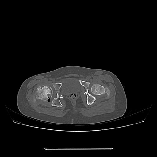 CT imaging of acetabular changes in Perthe\'s disease. | Eurorad