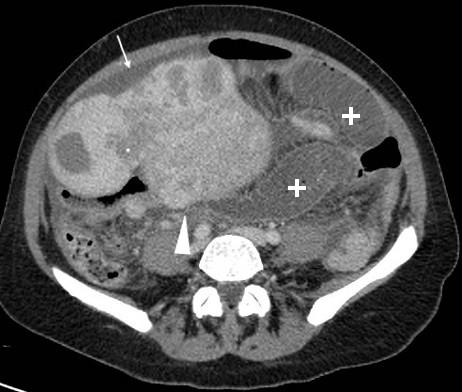 Giant uterine leiomyomatosis causing small bowel obstruction | Eurorad
