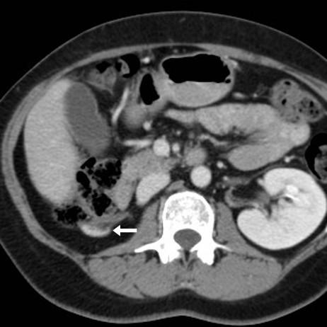 High-grade iatrogenic renal injury after adrenalectomy | Eurorad