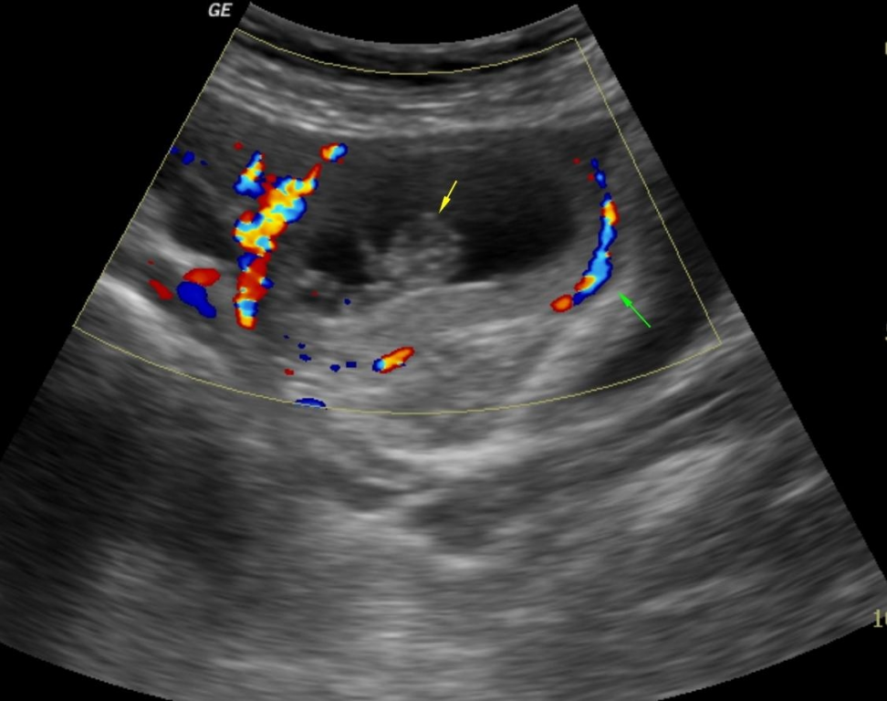 Chapter 8 – Sonographic Assessment of Ovarian Cysts and Masses | Obgyn Key