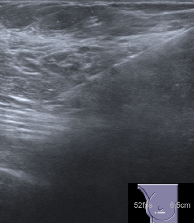 A Rare Case Of A Benign Breast Lesion Eurorad