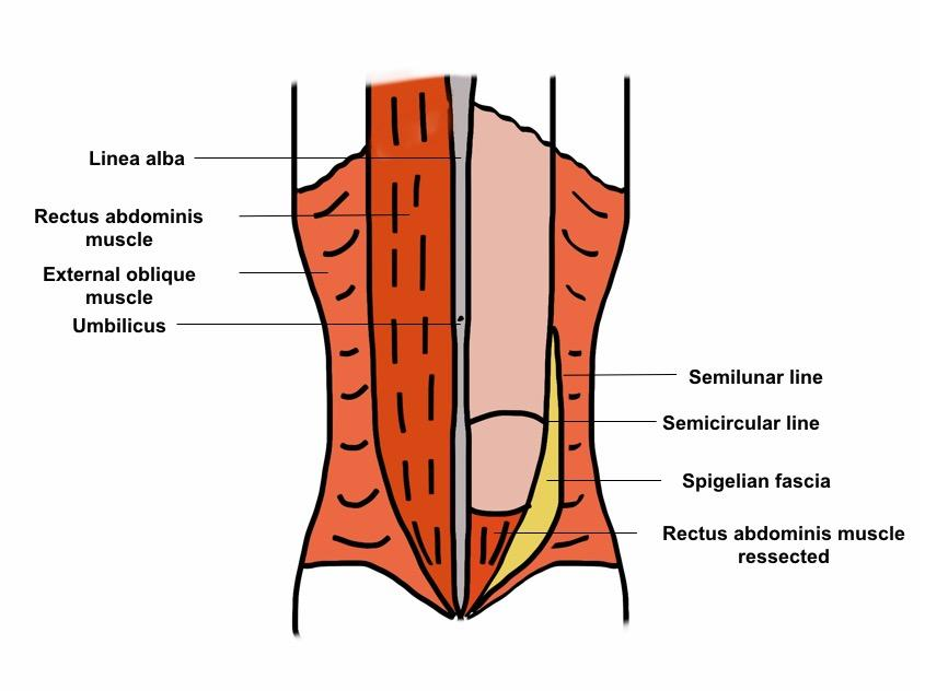 An unusual case of right lower quadrant pain: Spigelian hernia | Eurorad