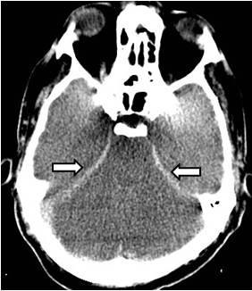 Severe hypoxic - ischaemic brain injury: the reversal, the pseudo ...