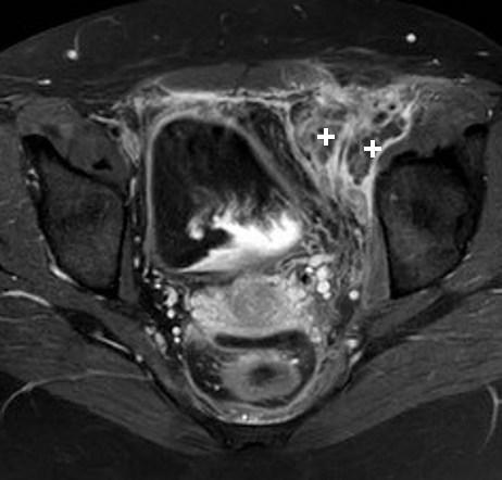 A rare, deceptive cause of lower abdominal pain: ilio-femoral septic ...