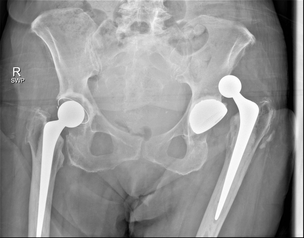 An Unusual Complication Of Hip Dislocation After Total Hip Replacement