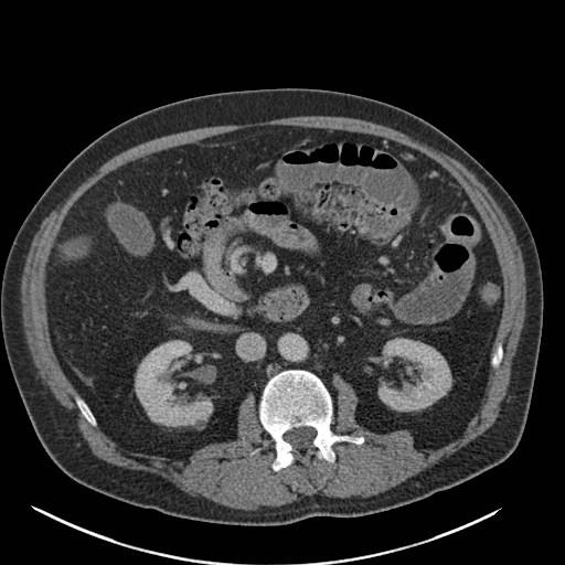 Case Report Midgut Malrotation With Faecolith A Rare Cause Of Small