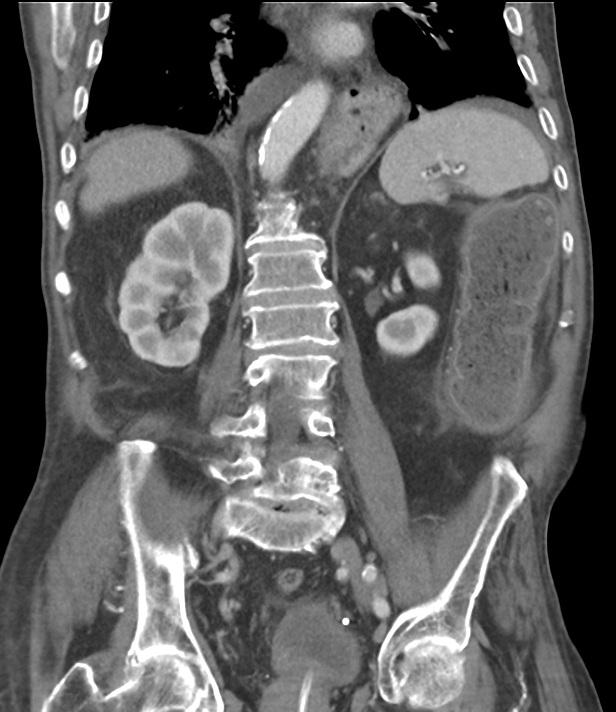 Cystitis with collapsed giant bladder diverticulum | Eurorad