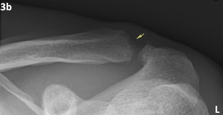 Distal Clavicular Osteolysis In A Bodybuilder Eurorad
