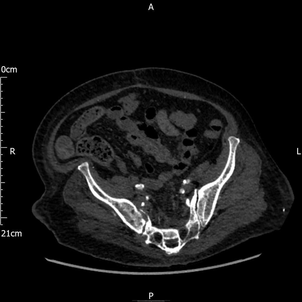 Ureto-Arterial Fistula - A rare cause of urinary tract bleeding. | Eurorad