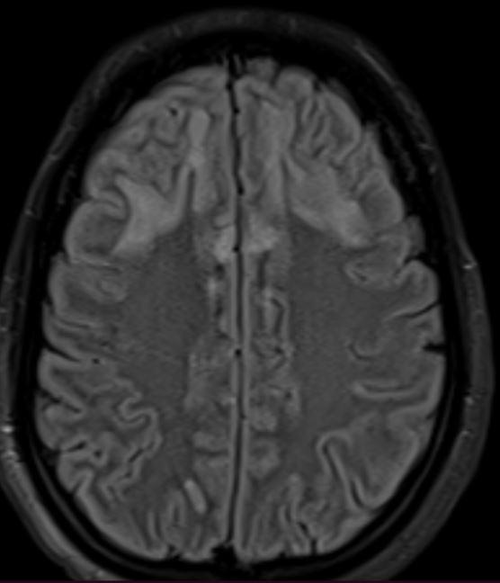 MRI findings in a case of acute methanol intoxication | Eurorad