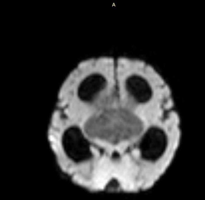 Pilomyxoid astrocytoma with leptomeningeal carcinomatosis | Eurorad