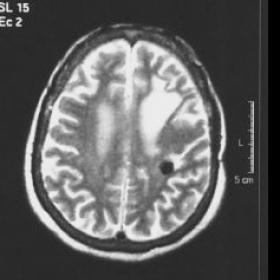 MR brain: axial T2 imaging