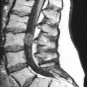 Pre-operative MRI  of the lumbar spine